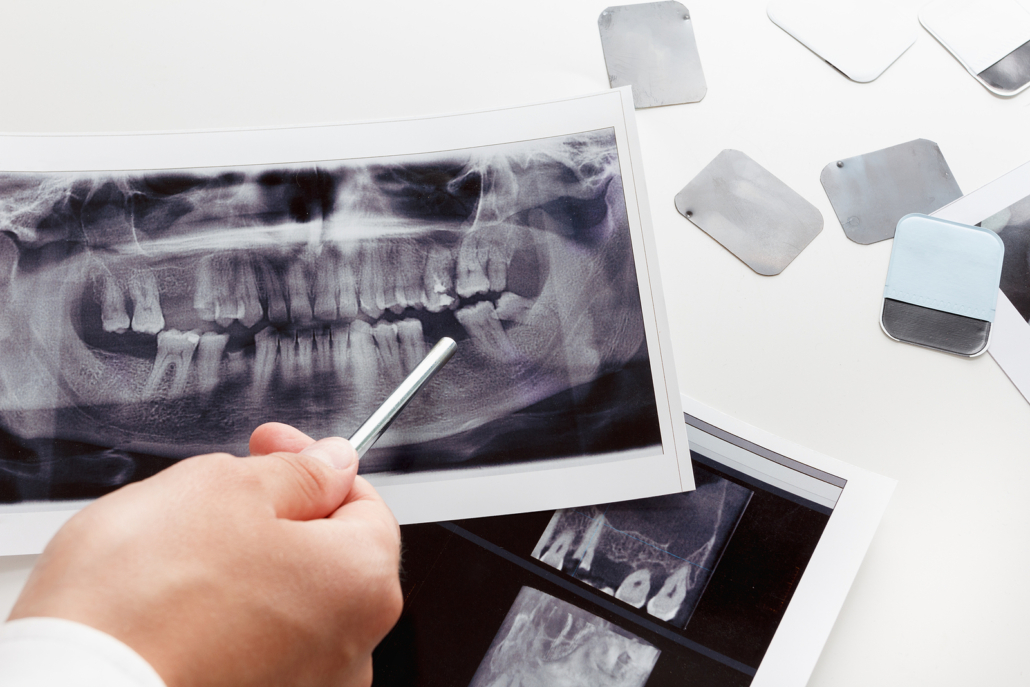medical imaging - X-ray dental problem scan
